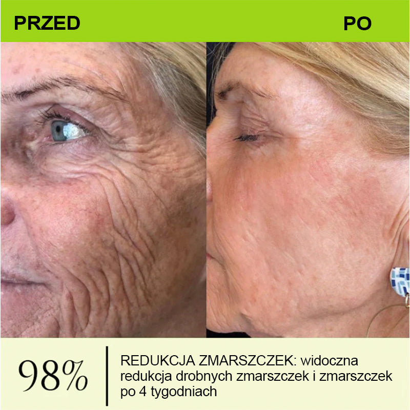[🔥Ostatni dzień: 70% taniej] Preparat Purelora® (efekt botoksu i retinolu) – sposób na głębokie zmarszczki, opadające policzki i opuchliznę pod oczami