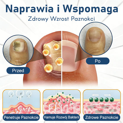 Purelora® – bioaktywny system głęboko wnikający przeciw grzybicy paznokci