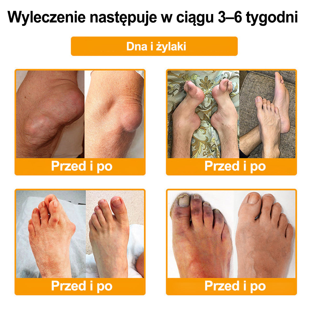 Purelora® – Krem przeciwbólowy i wspomagający regenerację kości z toksyną botulinową i jadem pszczelim