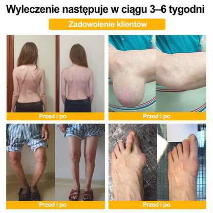 Purelora® – Krem przeciwbólowy i wspomagający regenerację kości z toksyną botulinową i jadem pszczelim