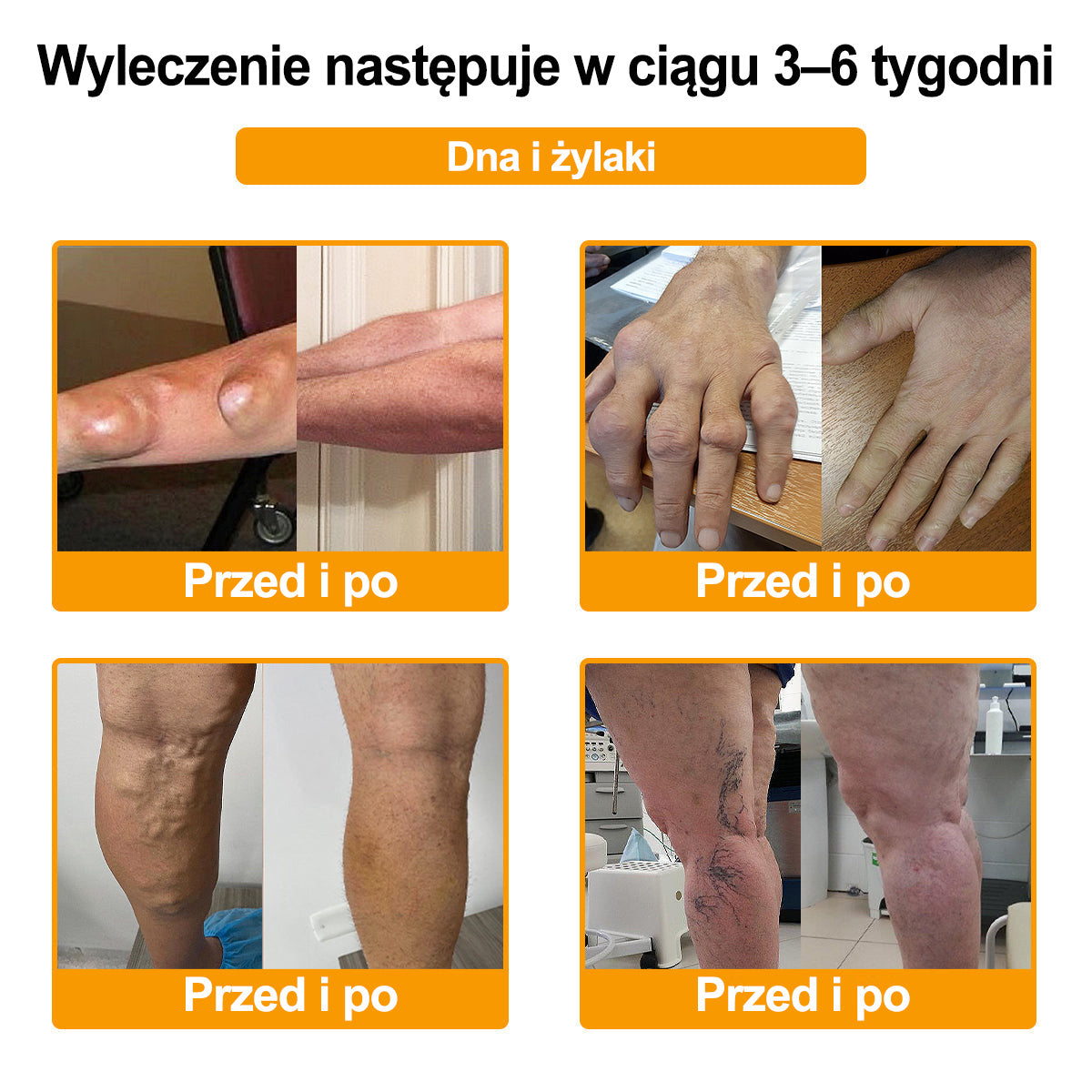 Purelora® – Krem przeciwbólowy i wspomagający regenerację kości z toksyną botulinową i jadem pszczelim