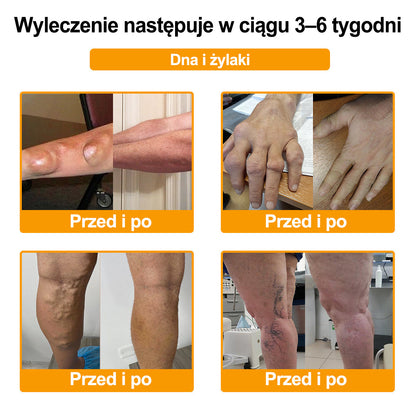 Purelora® – Krem przeciwbólowy i wspomagający regenerację kości z toksyną botulinową i jadem pszczelim
