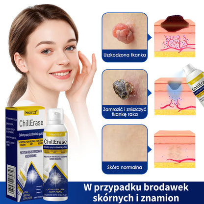 ❄️Healrize® ChillErase – Delikatny spray regenerujący na uporczywe grudki i szorstkie miejsca na skórze