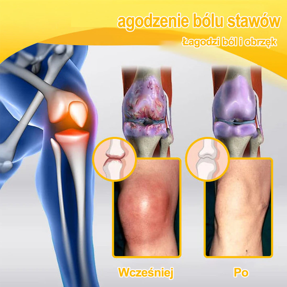 Purelora® – Krem przeciwbólowy i wspomagający regenerację kości z toksyną botulinową i jadem pszczelim