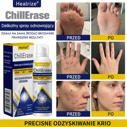 ❄️Healrize® ChillErase – Delikatny spray regenerujący na uporczywe grudki i szorstkie miejsca na skórze